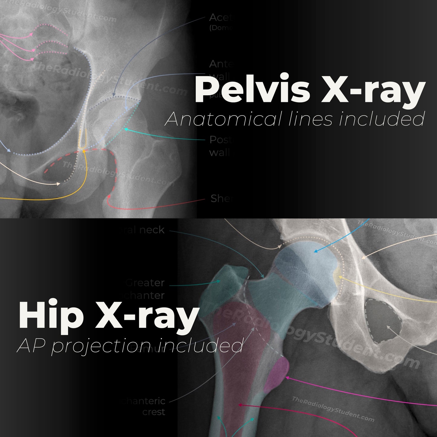 Pelvis and hip xray quiz | Study guide for radiology student