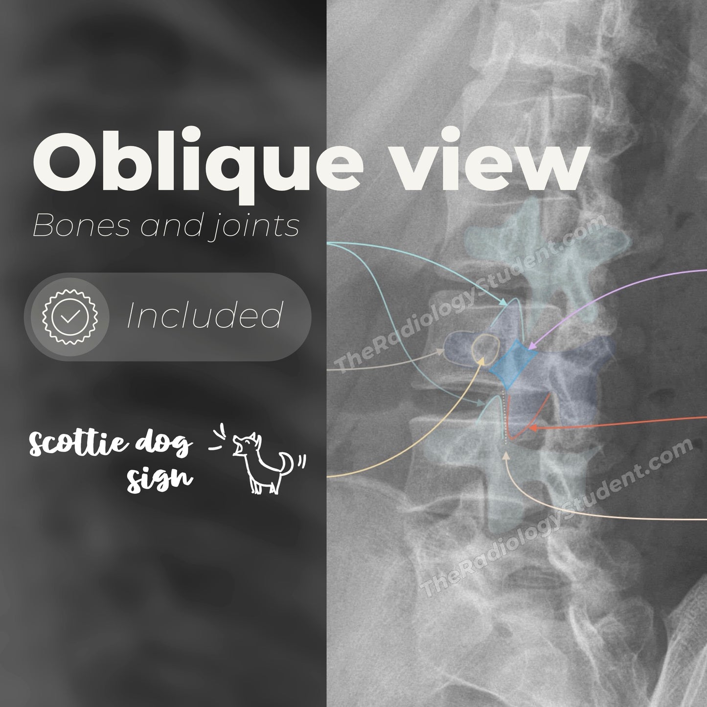 Lumbar spine radiographic anatomy | Annotated x-ray quiz